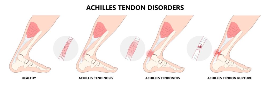 Jermaine Johnson, Jets pass rusher, sustains right Achilles tendon injury and is carted off field